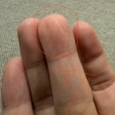 울산비비성형외과의원 | 울산 응급실보다 성형외과 봉합 추천해요(어린이 유아 봉합후기)