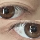 맑은수정약국 | 눈 충혈인줄 알았던 결막모반 레이저 제거, 실비청구 후기(부작용 결막염?)