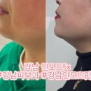 라인피부과의원 | [강남역] 얼굴 인모드 FX 강남 피부과 VS라인의원 강남점 이중턱 제거 후기!!