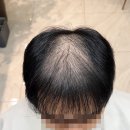 315 | 대구 남자 탈모커버 미용실 헤어315 링거펌 후기
