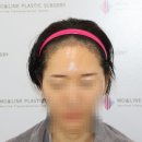 11545-12-06-10 | ④ 수술 후 10개월차_안면거상 전문 원장님도 추천하는 모앤라인, 40대 여성 모발이식 리얼 후기