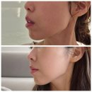 맘에든 한의원 | 드림핏한의원 볼뉴머 컷약침 솔직후기