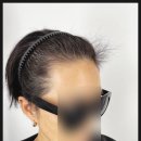 동해탈모 커버 동해두피시술 [씨와이스캘프] 리얼만족후기