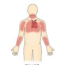 가슴 답답함 가슴통증 원인 협심증 이미지