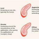 Diffuse adenomyomatosis, GB 이미지