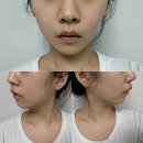 자연미한뱡병원 | 청담 피부과| 온다티타늄으로 얼굴라인 관리 예신에게 탁월한 시술 효과, 후기