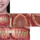 피어나의원 - 천안시 서북구 성성8로 2-7 | 김포 풍무동 교정치과 | 만족도 높은 앞니 부분교정의 장단점