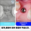 에이플란트치과의원 네이버블로그