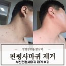 가야한의원 | 부산쥐젖제거 편평사마귀 한의원에서 308개 제거한 솔직후기