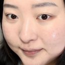 멍이랑옹이랑 | 운정리투오 파주리투오 잘하는곳 스킨부스터 내돈내산 통증