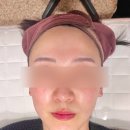 씨유 일산우인점 | 일산피부관리 주엽피부관리, 미모부심 큐라젯 후기 효과 전후비교