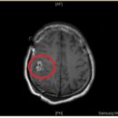 42번글 교모세포종 종양완전 소멸사례!, 기공 전후 MRI비교 자료입니다 이미지