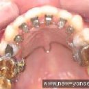 치아교정 기간이 길어질 수 있는 위험요소 5가지 이미지