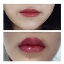 삼일한방사우나 | 성형외과 3중마취(마취크림+마취액+극소마취주사)입술필러후기/진짜아픔잘느끼는사람입술필러 삼일차찐후기