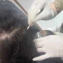 대구달서구탈모 케이뷰티 후기