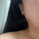 이상지 | 중계의원 다녀온후기 2탄 흉터후기