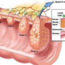 대장암 예방법과 초기 증상, 원인과 치료법, 대장암에 좋은 음식 이미지