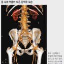 약해진 뇌혈관은 시한폭탄… 부풀어 터지면 30％ 숨져 이미지