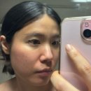 하이필스킨 | 여드름, 흔적, 모공 관리 추천 찐후기 | 바디테라피 | 몸건강부터 피부건강까지 | 장벽필링