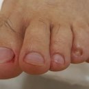 나도손톱 레푸스 개봉점 이미지