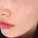 톤 워커 | 광화문피부과 토닝레이저 스타워커 기미 잡티 치료 전후 후기