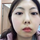 산본엘치과의원 | [산본엘치과]매복사랑니 발치후기