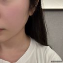 작년에갔던 | 목동역 피부과 온다리프팅 60kj 후기(통증 및 효과), 유지기간, 시술 후 주의사항