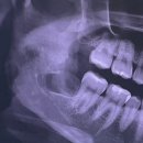 김재영치과의원 | 강남 세브란스 / 매복 사랑니 발치 (구강악안면외과 김재영 교수님)