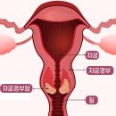 매년 검사 권고 '자궁경부암 이미지