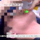 수원수염제모 젠틀맥스프로플러스 남자얼굴전체 부위 시술동영상 2026_07_01 인계동 원스의원