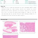 4/6 포비 스케일링 및 종괴 제거 (+조직 검사결과) 이미지
