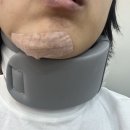 쌩쌩한의원 | 갑작스런 깊은 상처 봉합 후기 - 분당 정자역 근처 봉합전문 ㅎㄸ성형외과