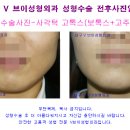 미스코성형, 사각턱 미간 보톡스 주사 비용은? 대구성형외과 쁘띠성형, 코성형 추천 이미지