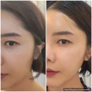 이중턱에서 브이라인으로 화원 피부샵 더빛나뷰티 싸이블로 리프팅 후기