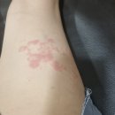 인용한의원 | 부산두드러기치료한의원? 졸레어주사 맞아도 재발하는 분들이 놓친 1가지