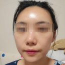 [예비신부 관리] 분당신부관리 가인미가 얼굴축소 &amp; 윤곽관리 후기
