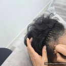 라인 | 둔산동 SMP 두피채움 헤어라인 관리후기