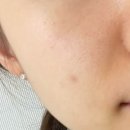 진성레이져 | [닥터 원진 플러스] 레이저 재생 크림 솔직 후기