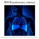 7강 방기제 예습 - 울혈성 심부전에 대하여 이미지