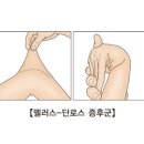 엘러스-단로스 증후군[Ehlers-Danlos syndrome] 이미지