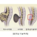 잠재성 이분 척추 이미지