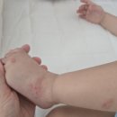 (주)엘아이에프이물산 | 16개월 아기 어린이집에서 수족구 옮아온 일기