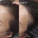 줄리아헤어 | 이마라인이 달라지면 인상이 달라집니다｜가든파이브 줄리아뷰티 헤어라인 교정