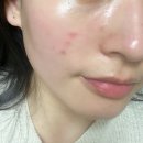 피지업 | 압구정역 피부과 피지 광채 톤업 고주파 덴서티 리프팅 후기