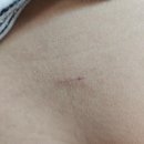 대전우리병원 | 6세 여아 탈장 | 대전 충남대병원 수술후기