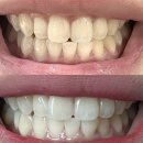 서울바른현치과의원 | [서울/당산] 당산 치과 치아화이트닝 원데이미백 내돈내산 후기