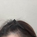 명지헤어라인 | 명지 헤어라인문신제거 가능한가요? 반영구 잔흔제거 실제 후기 포함”