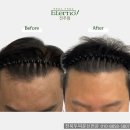 디자인1235 | 전주두피문신 가격·비용·효과 후기, 솔직하게 말씀드립니다