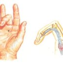 [손가락인공관절]손질환및 치료법 이미지