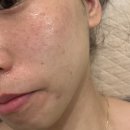 통증없는 스킨부스터 쥬베룩미라젯 안양피부과 추천